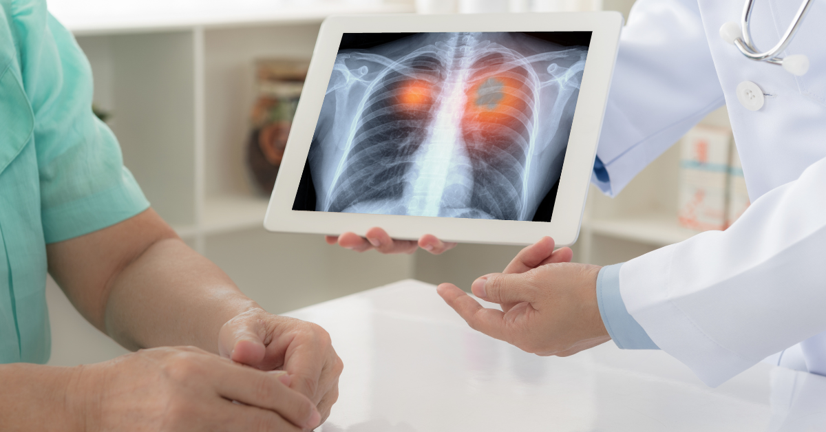 يقوم Thermo Fisher بتطوير اختبار جديد لخزعة زرع الرئة يقوم Thermo Fisher بتطوير اختبار جديد لخزعة زرع الرئة